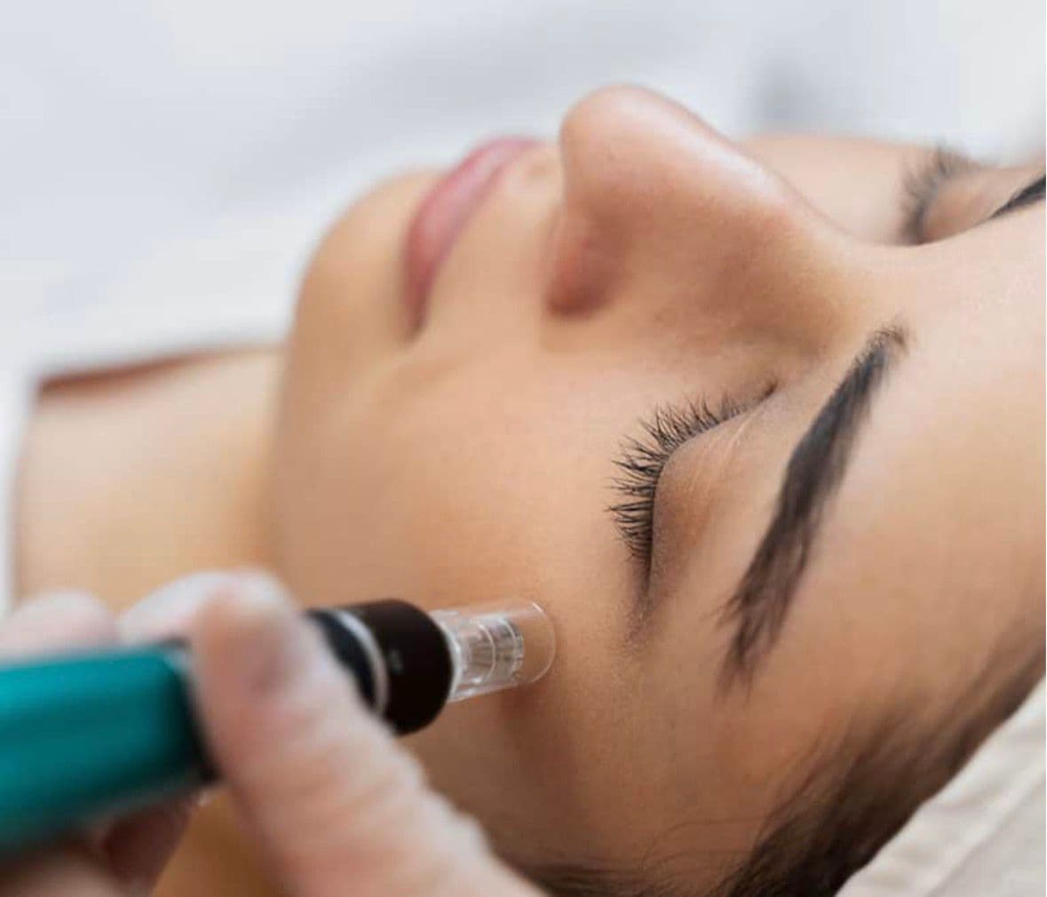 טיפול מיקרונידלינג מקצועי - חידוש העור בקריית ים