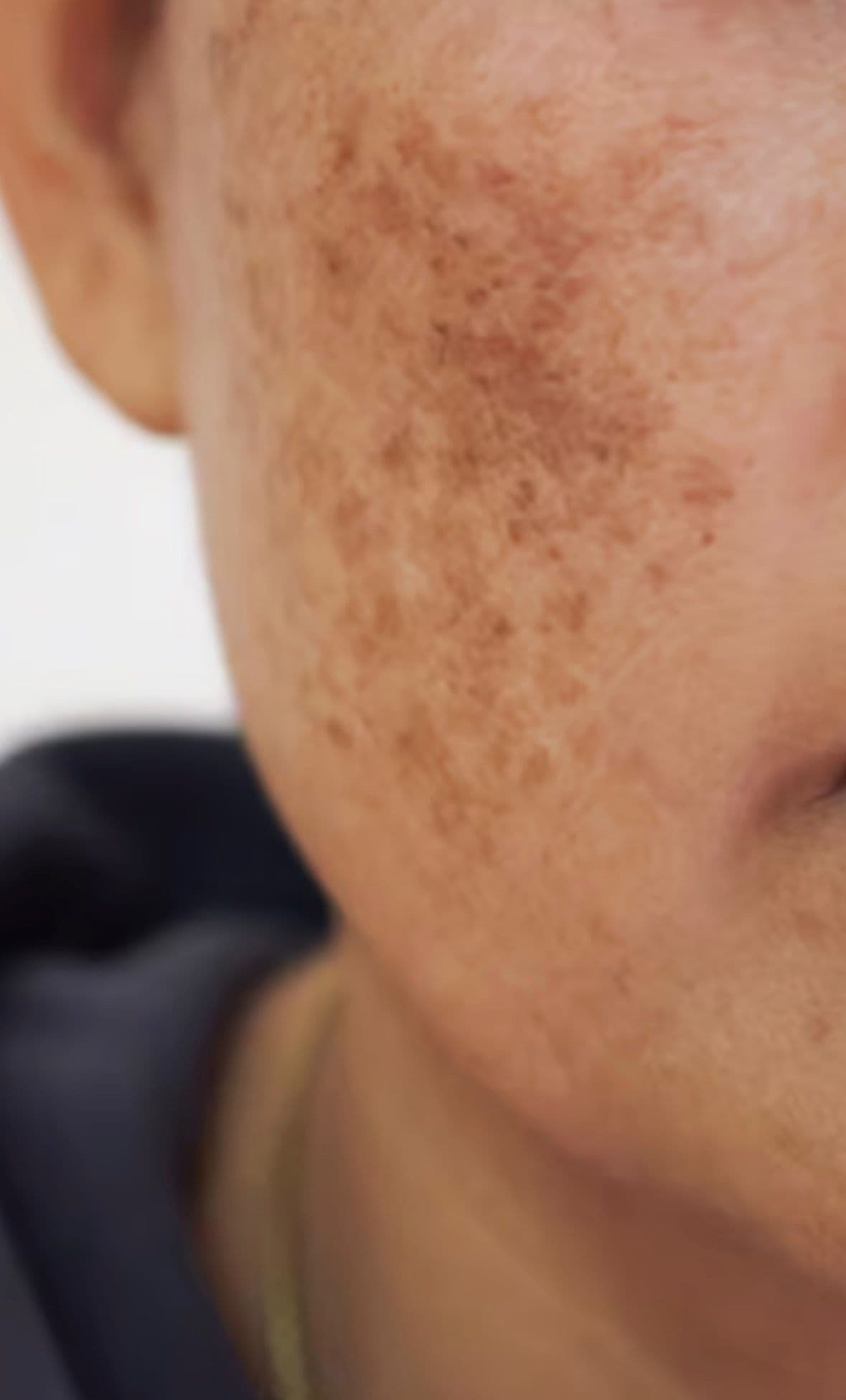 טיפול פיגמנטציה וכתמי שמש - הבהרת העור בקריות