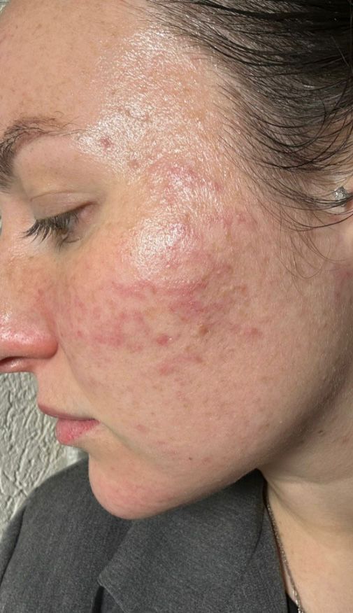 לפני הטיפול